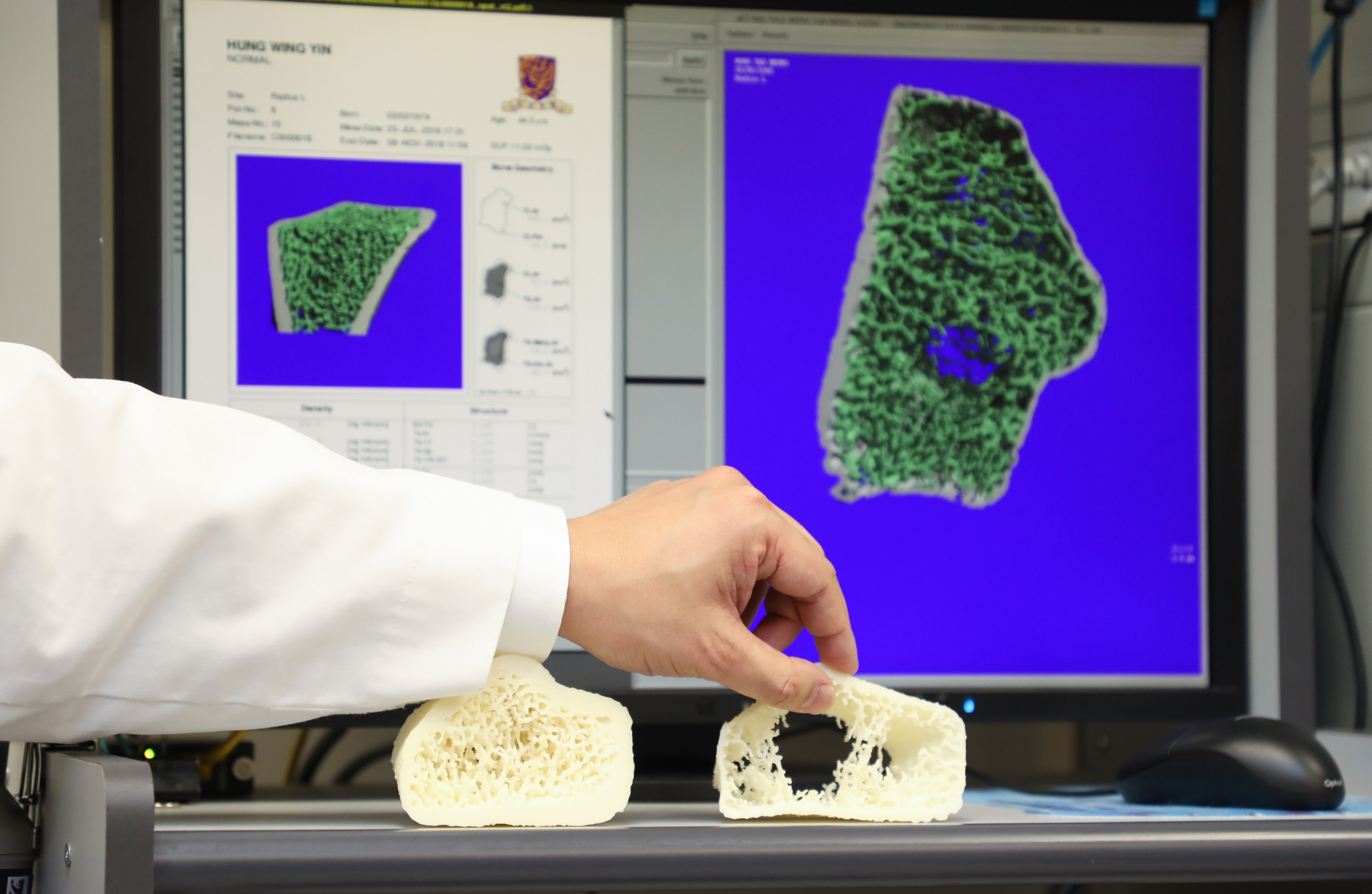 容樹恒教授解釋，「3D高解像度肢體骨定量電腦掃描 （HR-pQCT）」儀器能顯示骨骼的微結構，有助早期骨質疏鬆的診斷。