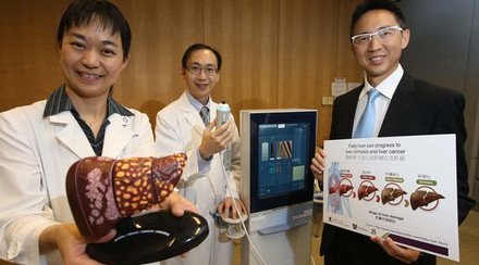 CUHK Discovers Fatty Liver Causing Severe Liver Fibrosis or Cirrhosis in 1 Out of 5 Diabetic Patients