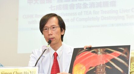 CUHK Reveals Effectiveness of TEA for Treating Liver Cancer with a 70% Chance of Completely Destroying Tumor