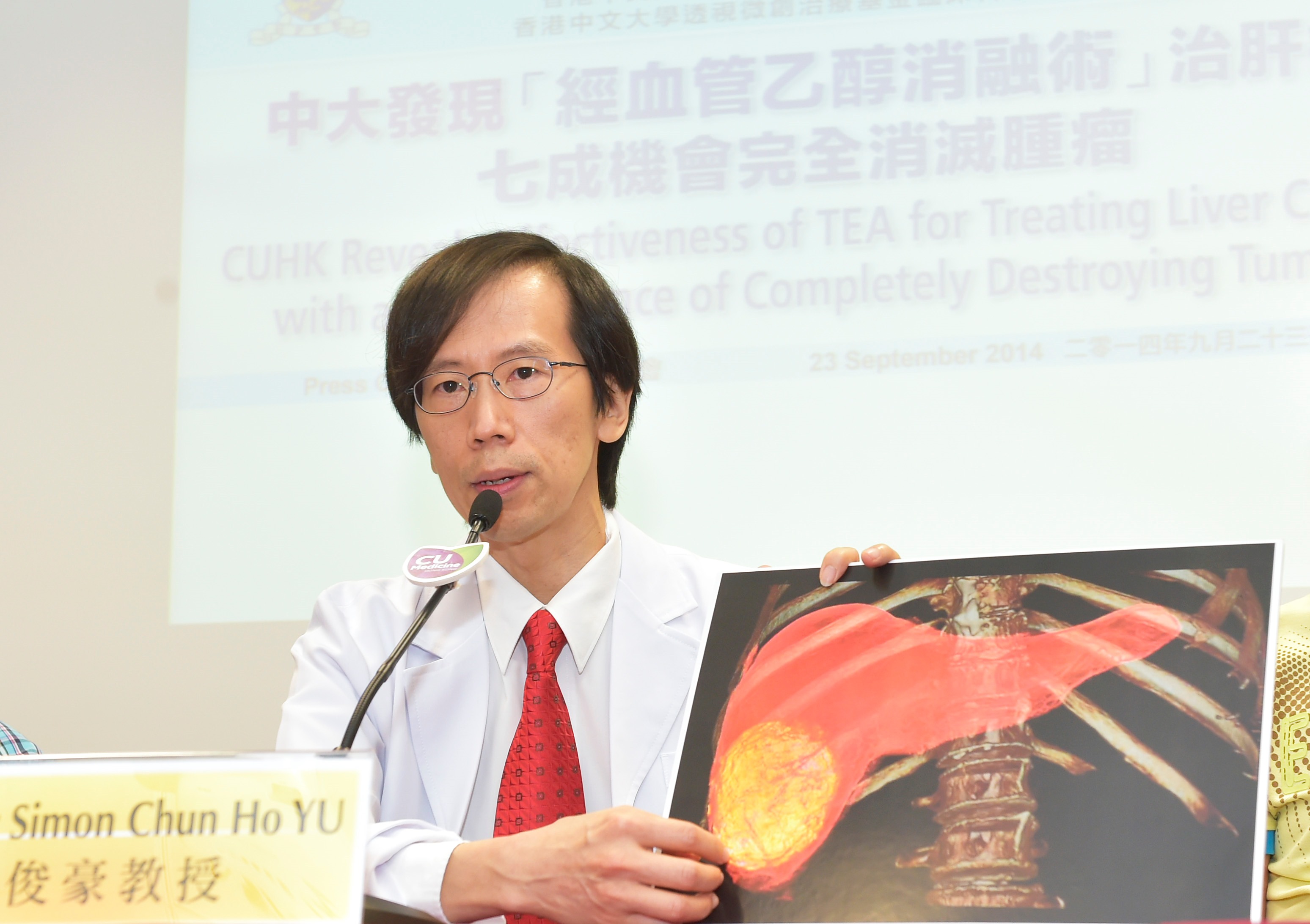 中大醫學院影像及介入放射學系余俊豪教授介紹「經血管乙醇消融術」治療肝癌的成效。