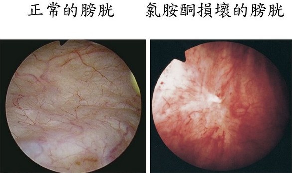 滥用氯胺酮会引致慢性膀胱发炎，甚至不可逆转的膀胱纤维化。