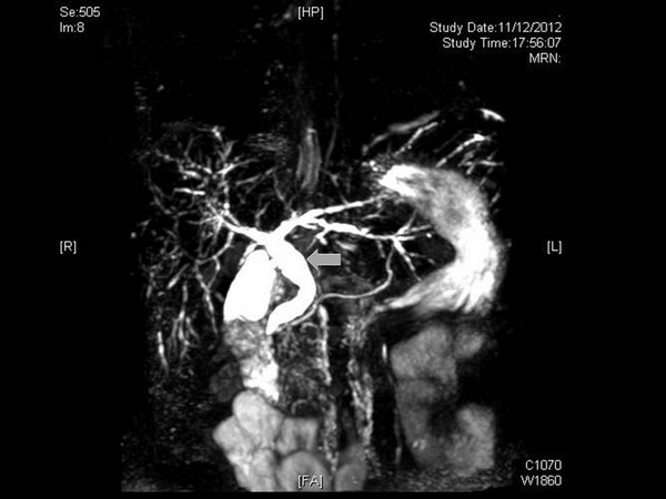 Over 40% of Ketamine abusers had abnormal liver function and even suffered from bile duct injury and liver fibrosis in some severe cases.