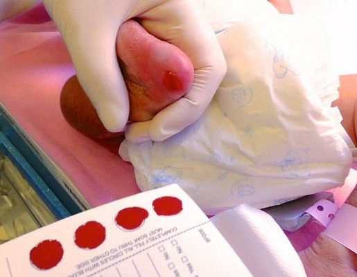 袁月冰醫生補充說新生兒代謝篩查只需在嬰兒腳部穿刺收集數滴血液，幾天後便可知檢測結果