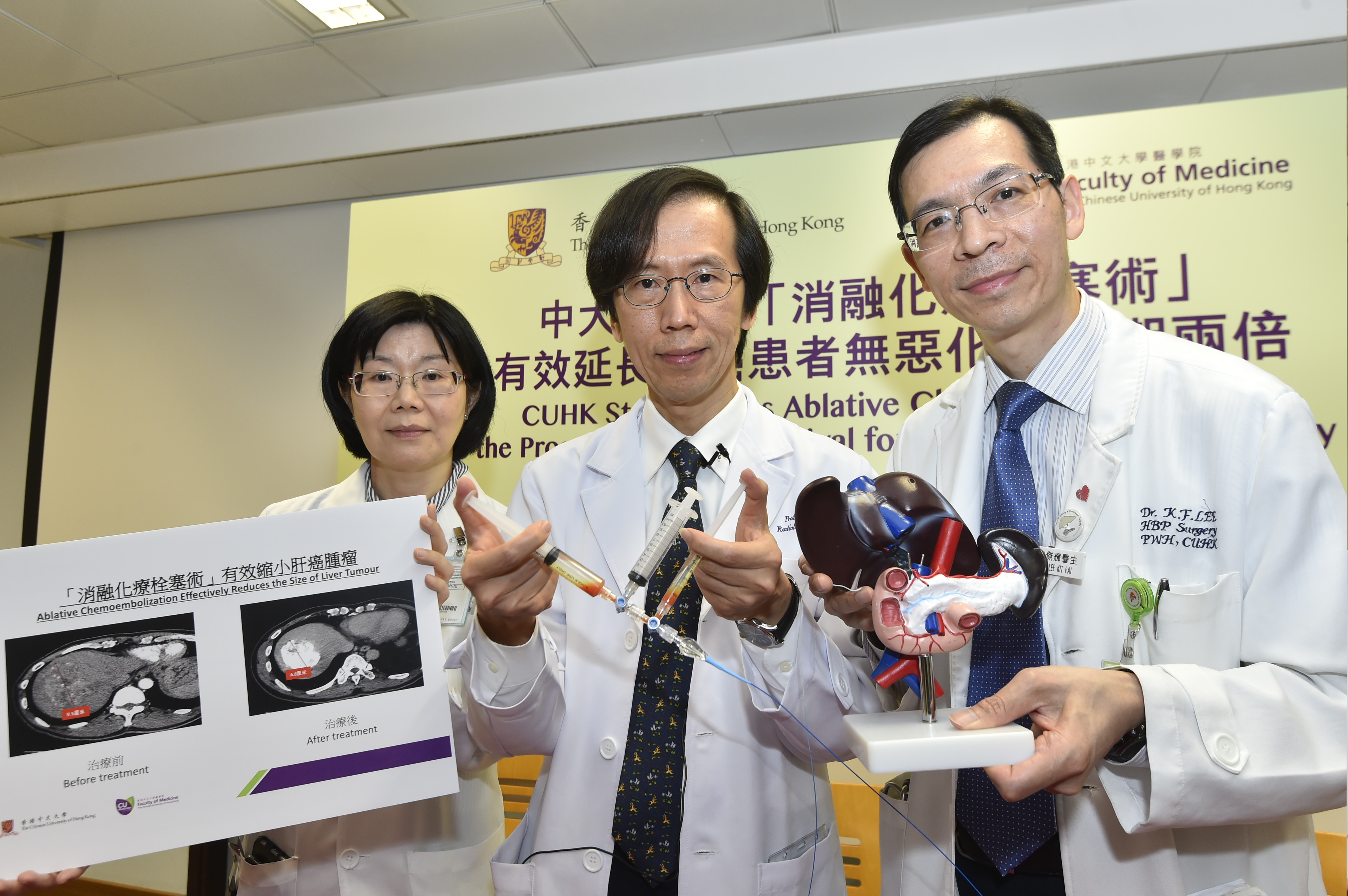 A study conducted by a multidisciplinary team of the Faculty of Medicine at CUHK proved that a new transarterial treatment named “Ablative Chemoembolization” (ACE) could double the progression-free survival of liver cancer patients at the intermediate stage, compared with conventional treatment. ACE is more effective in killing tumour cells of liver cancer patients and some of them could receive hepatectomy, with the aim of curing the disease. From left: Prof. Winnie YEO, Professor of the Department of Clinical Oncology; Prof. Simon YU, Chairman of the Department of Imaging and Interventional Radiology; Dr. Kit Fai LEE, Clinical Associate Professor (honorary) of the Department of Surgery, from the Faculty of Medicine at CUHK. 