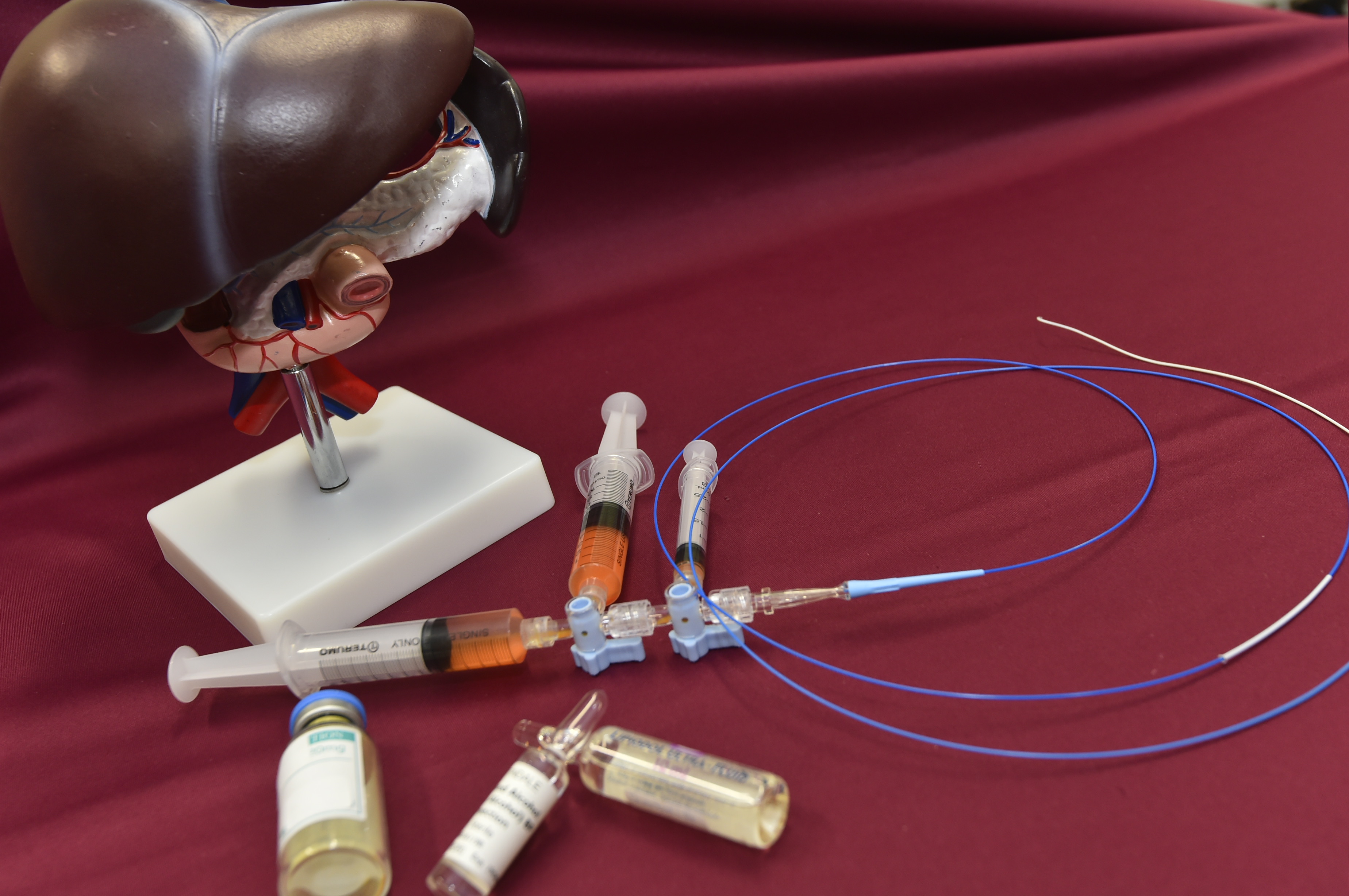 Ablative Chemoembolization can deliver concentrated chemotherapeutic drugs to liver cancer tissue through catheter and other devices. Combined with the effect of ethanol ablation and cutting off the blood supply of liver cancer tissue to cause ischemic necrosis, it can achieve multifold antitumour effect and improve the overall treatment outcome.