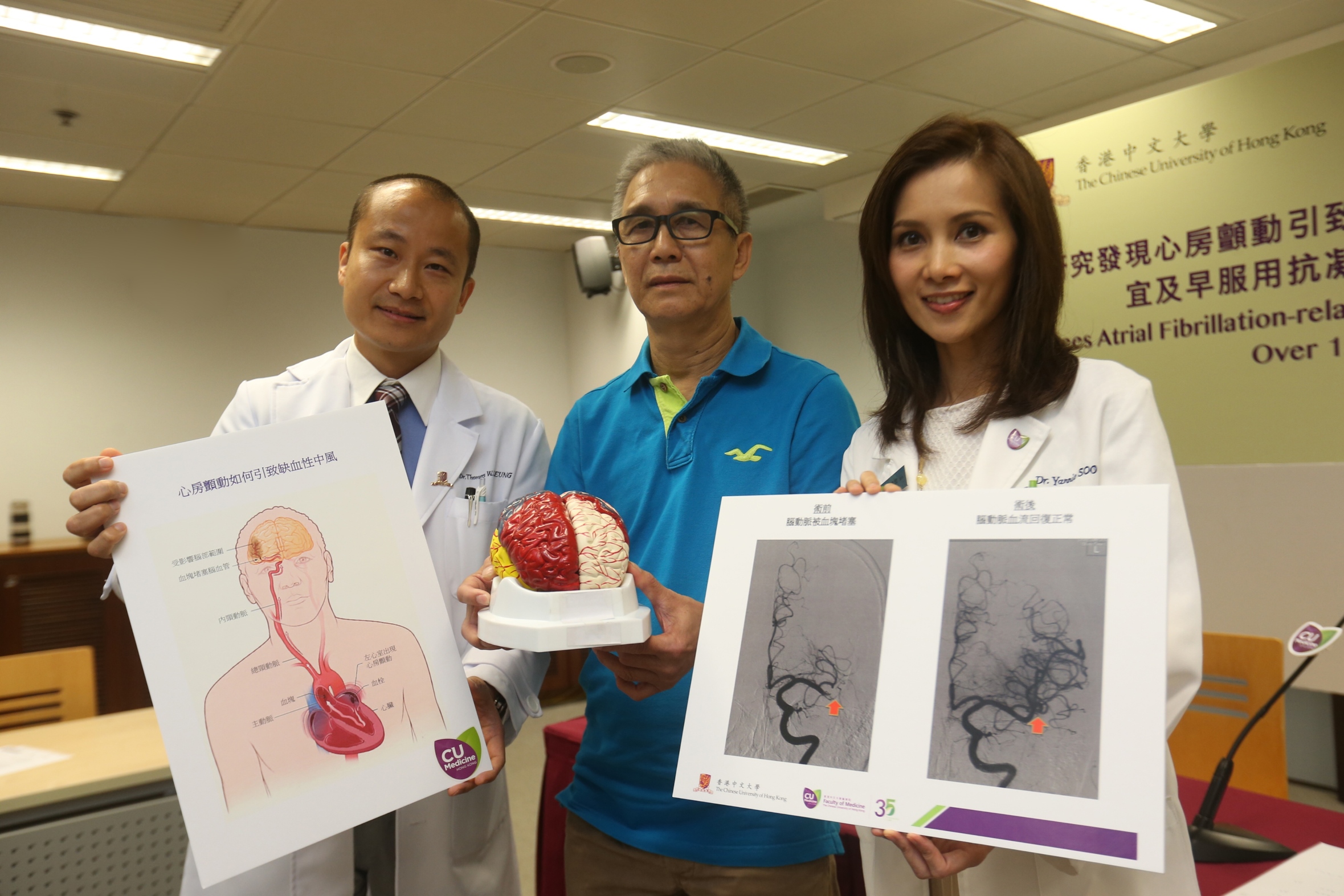 A research conducted by the neurology team from the Faculty of Medicine at The Chinese University of Hong Kong shows that the number of Atrial Fibrillation-related stroke cases has seen 3 times higher over 15 years. (From left) Dr. Thomas LEUNG, Lee Quo Wei Associate Professor of Neurology, Department of Medicine and Therapeutics, Faculty of Medicine at CUHK; Sharing patient Mr LOK; and Dr. Yannie SOO, Clinical Professional Consultant, Division of Neurology, Department of Medicine and Therapeutics, Faculty of Medicine at CUHK.