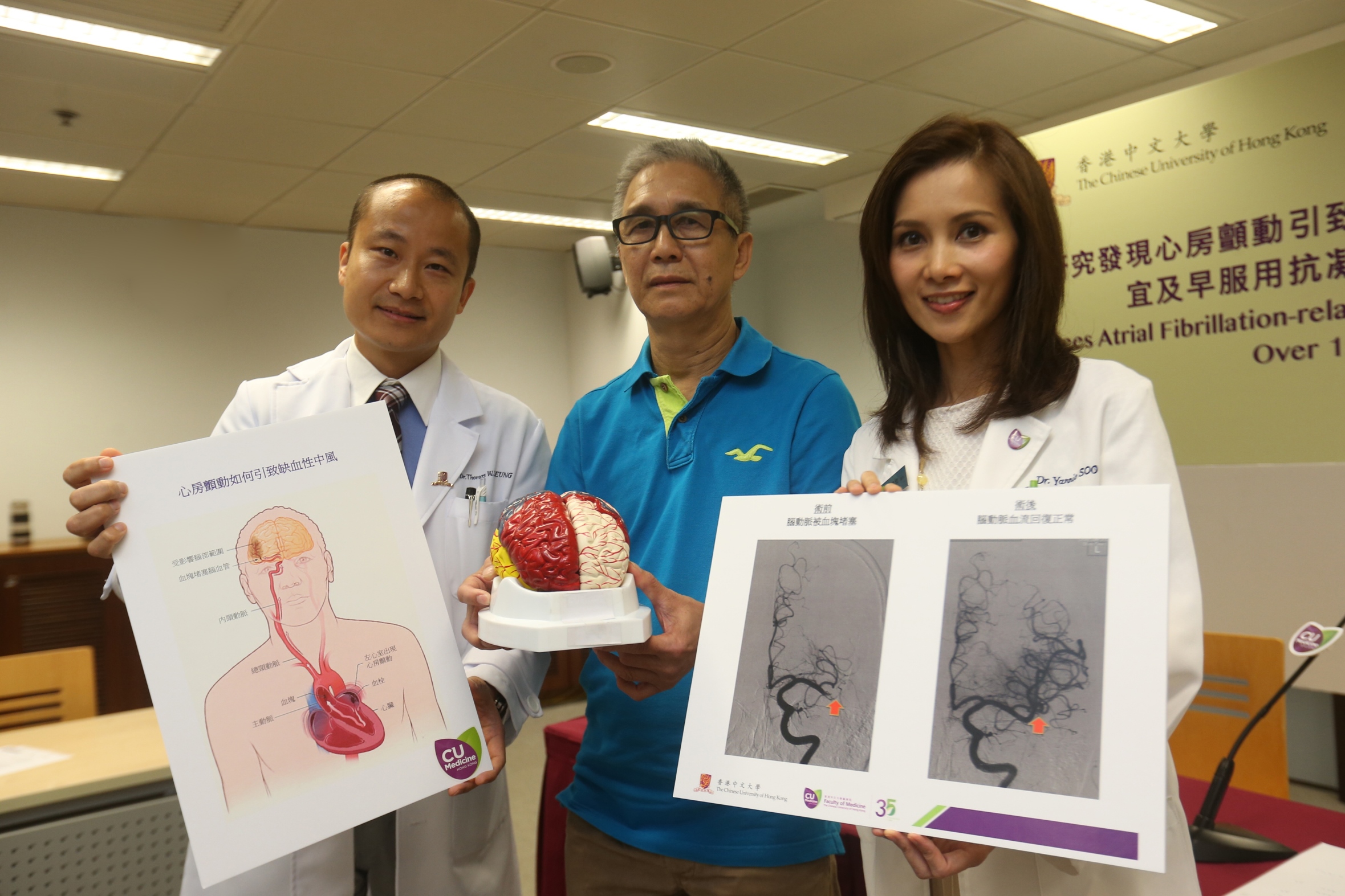 中大医学院脑神经科团队研究发现，本港因心房颤动引致缺血性中风的患者过去15年增加3倍。左起：中大医学院内科及药物治疗学系利国伟脑神经学副教授梁慧康医生、分享个案骆先生，以及中大医学院内科及药物治疗学系脑神经科临床专业顾问苏蔼欣医生。