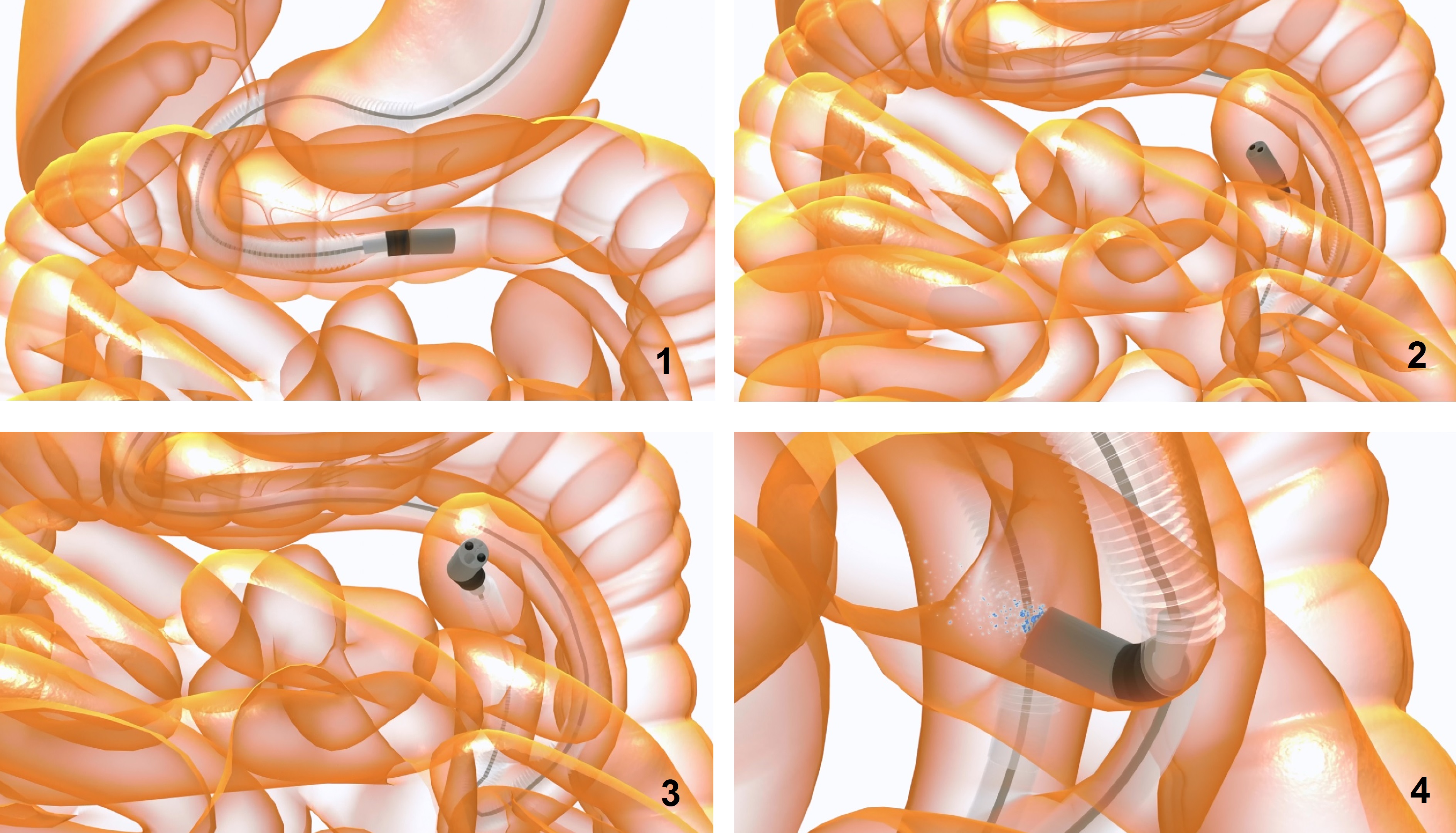 磁力導航內窺鏡在小腸運作的模擬圖。