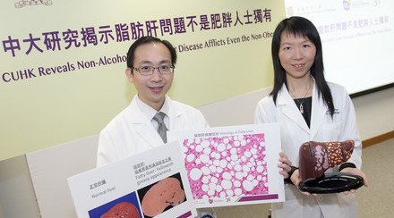 CUHK Reveals Non-Alcoholic Fatty Liver Disease Afflicts Even the Non-Obese