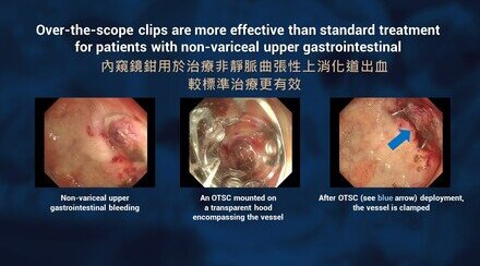 CUHK finds over-the-scope clips are more effective than standard treatment for patients with non-variceal upper gastrointestinal bleeding