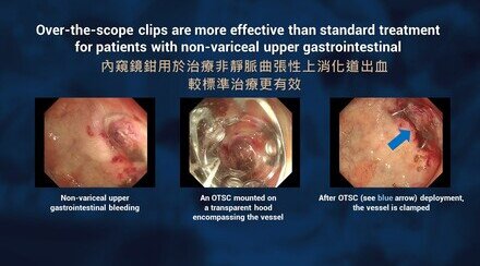 中大研究發現「內窺鏡鉗」用於治療非靜脈曲張性上消化道出血 較標準治療更有效