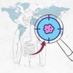 CUHK’s study sees small intestinal cancer incidence rising globally and in Hong Kong Higher incidence observed in high-income countries