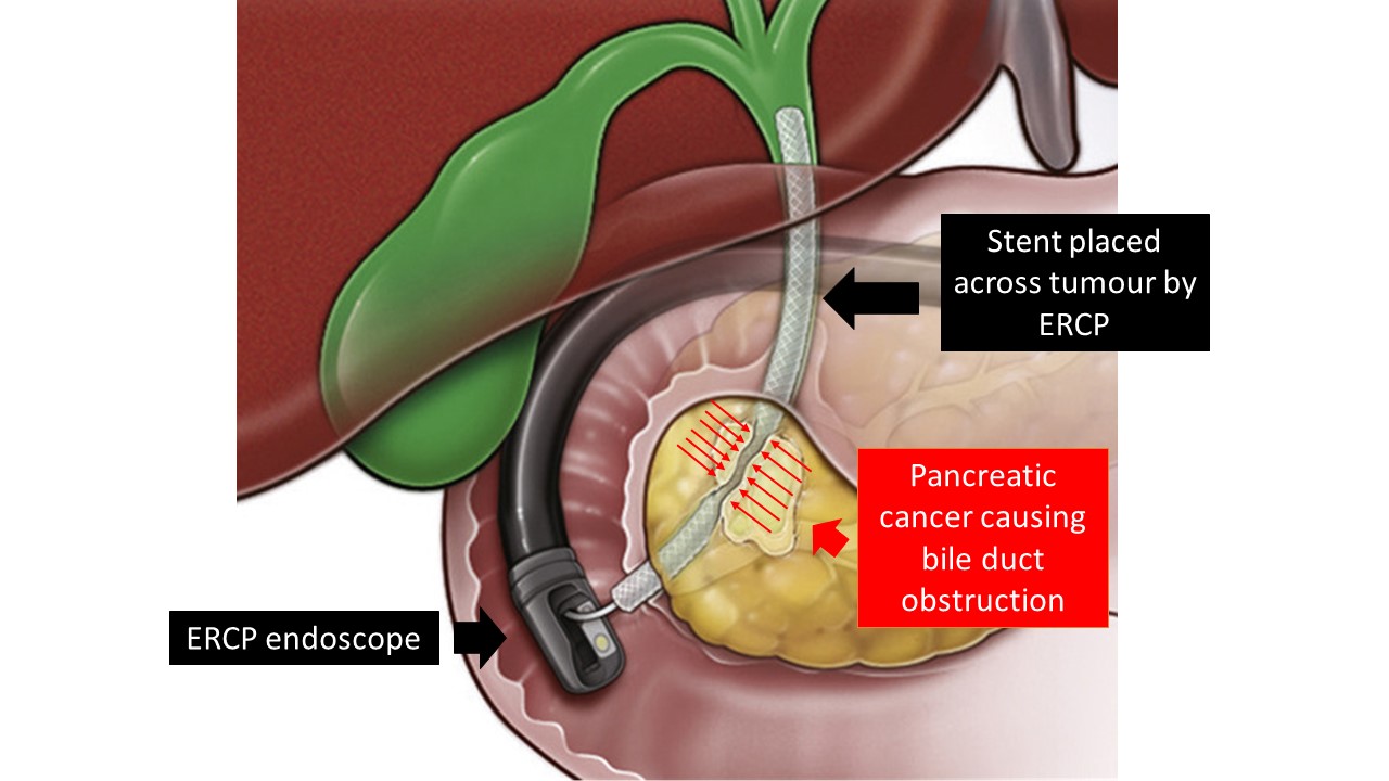 ERCP