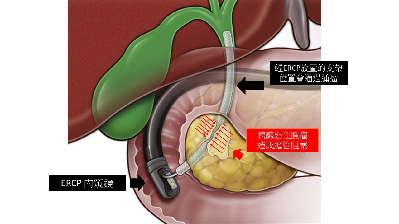 內窺鏡逆行胰膽管造影術
