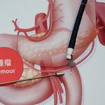 中大医学院证实内窥镜胃肠绕道术治疗恶性胃出口阻塞 成效更高、住院时间更短