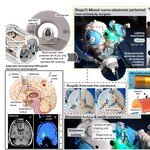 中大与港大共同开发互动式多阶段机器人定位器 以术中磁力共振引导 用於立体定位神经外科手术