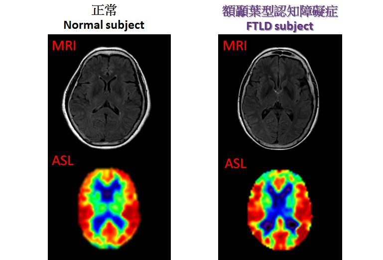 磁力共振用於顯示腦部結構性改變，但有機會未能偵測早發性額顳葉型認知障礙症患者的初期異常情況。是此次研究中嘗試運用的一種先進磁力共振序列－動脈自旋標記技術（MRI-ASL）能在單一掃描中同時尋找出腦部結構性和功能性的改變。