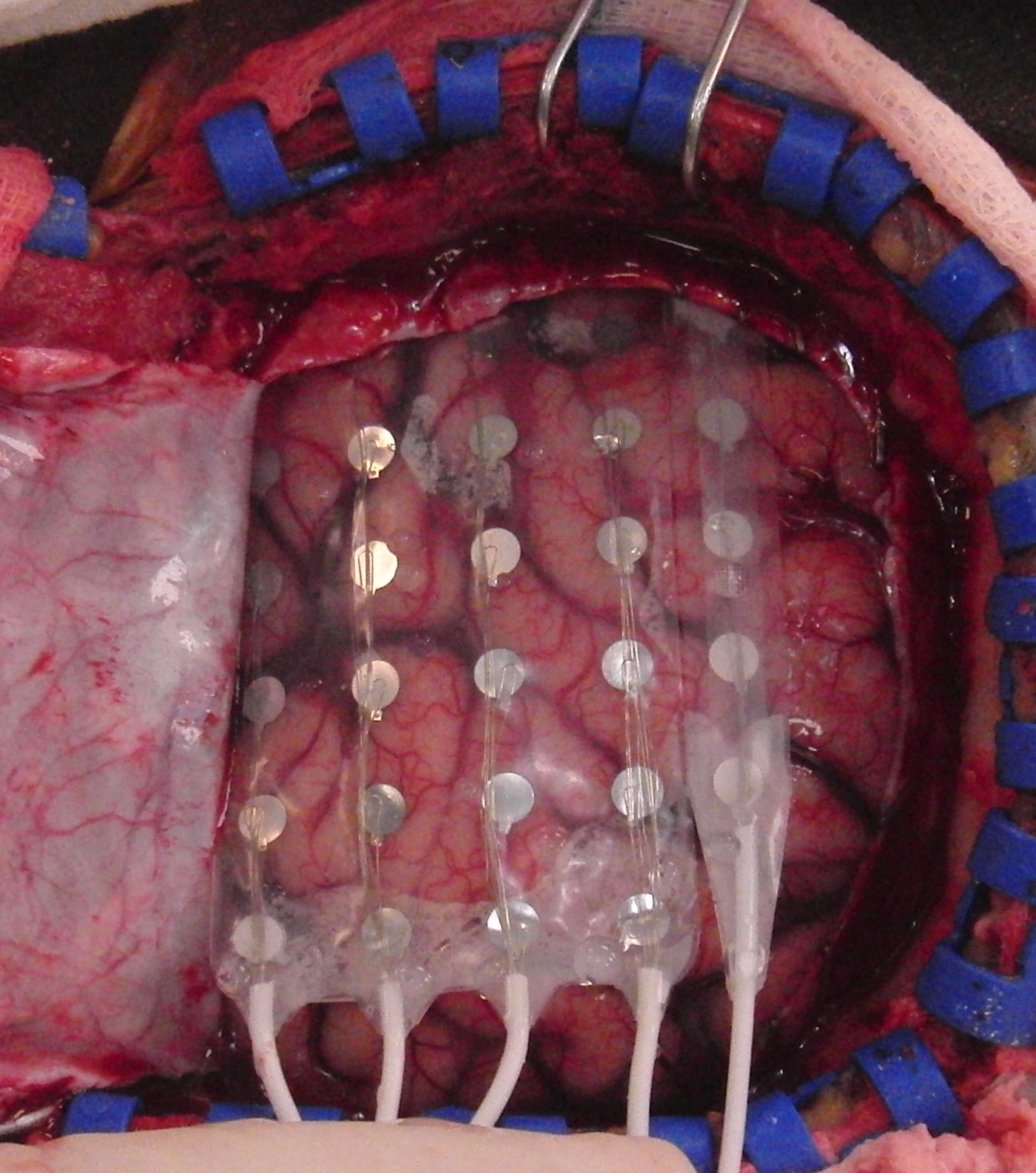 Those epilepsy cases without consistent results from non-invasive investigations will be defined as complex cases. Patients can consider undergoing an operation to place electrodes onto the brain surface or into the brain substance, where the electrodes record electrical signals directly from the brain. The signals will then be analyzed to accurately locate the focal seizure origin.